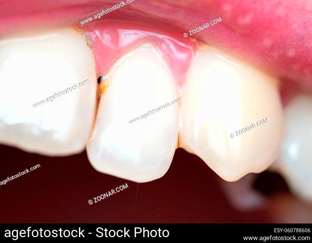 Closeup of dental plaque on man's teeth caused by coffee residual