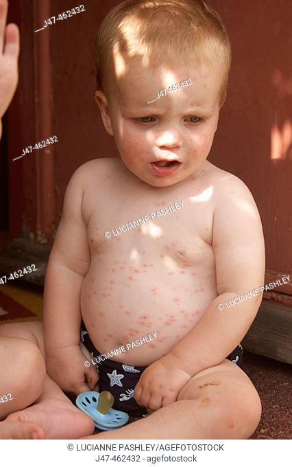 1 year old boy sitting on a step covered in chicken pox