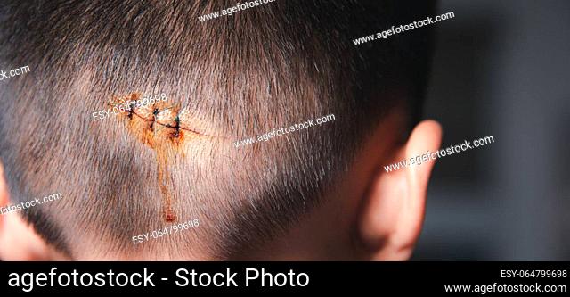 The lacerated sutured wound of kid back head which suture by nylon suture about 3 stitches at the emergency room of the hospital