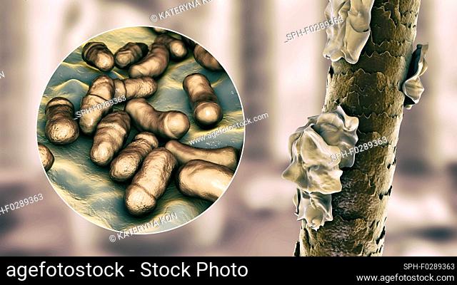 Computer illustration showing human hair with dandruff and close-up view of microscopic fungi Malassezia furfur associated with seborrhoeic dermatitis and...