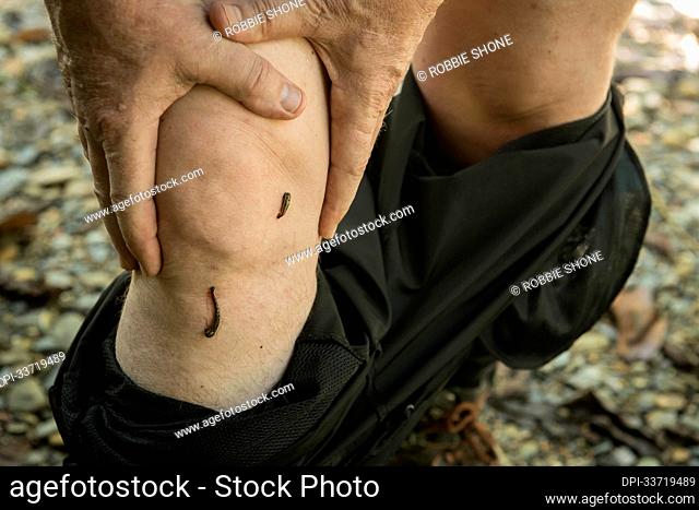 Man stands showing two leeches on his leg, Gunung Mulu National Park; Sarawak, Borneo, Malaysia