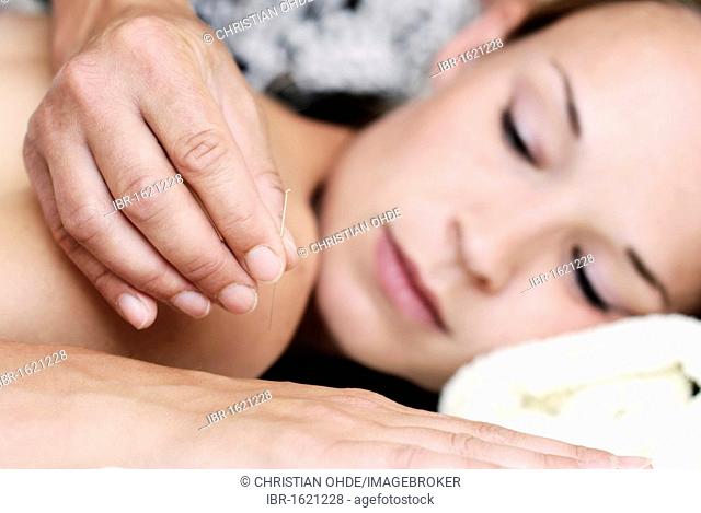 Young woman receiving acupuncture therapy in a natural healing practice