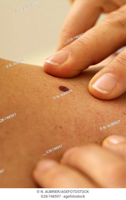 Dermatologist examining mole on patient