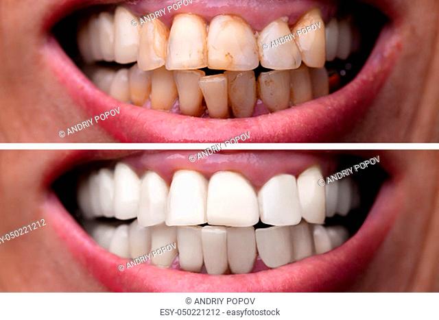 Female Teeth Between Before And After Dental Treatment