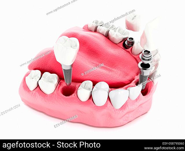 Illustration of teeth showing dental implant structure