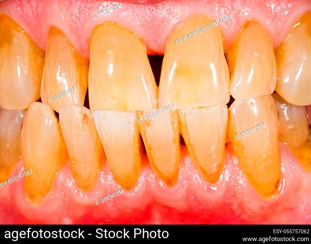 Close up photo of porcelain, zirconia teeth in human mouth