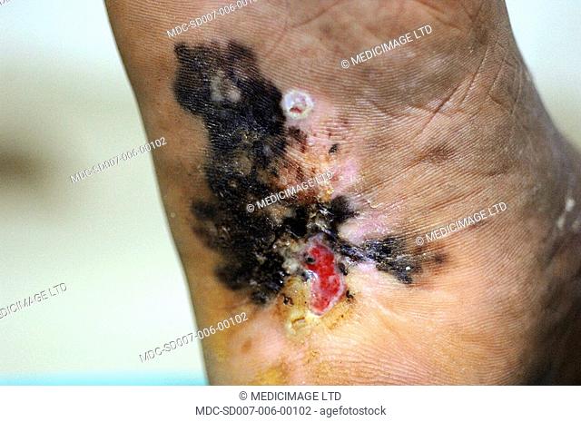 Close-up of a malignant melanoma on the heel of an elderly woman. Melanoma is a malignant tumor of melanocytes pigment producing cells found in the skin