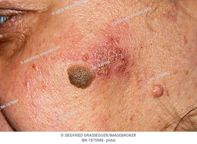 Inflamed skin rash due to a chromium-nickel allergy and seborrheic keratosis, seborrheic verruca or senile wart on the face of a woman