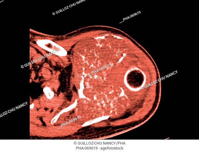 Colored enhanced Axial Computed Tomography CT scan of the shoulder showing a chondrosarcoma of the shoulder blade. The tumor is evidenced by the presence of a...