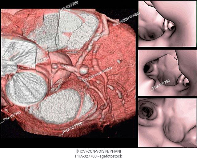 3D computed tomographic CT scan reconstruction of left coronary artery aneurysm, with views of the aneurysm from the inside at right