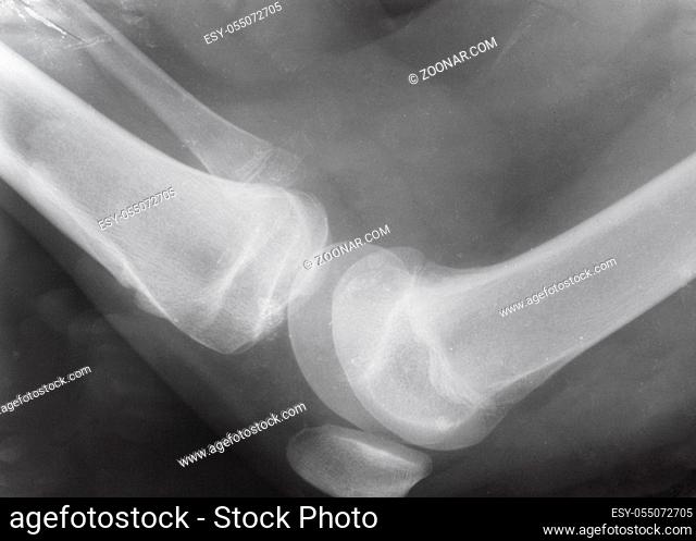 side view of human knee joint with patella on X-ray image