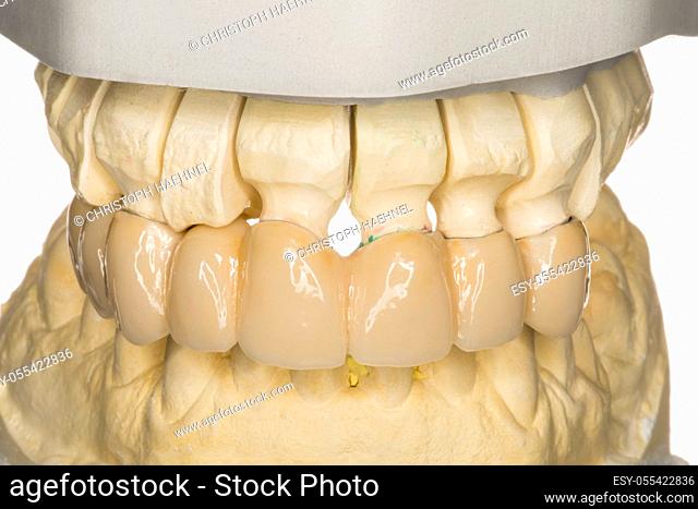 dentures, Ceramic bridge