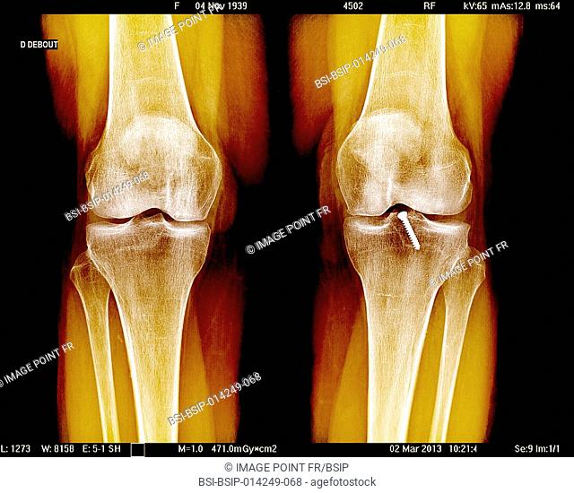 Knee x-ray on a 73-year old woman. The exam shows widespread bone demineralisation, a discrete pinching in the internal femorotibial joint space and an...