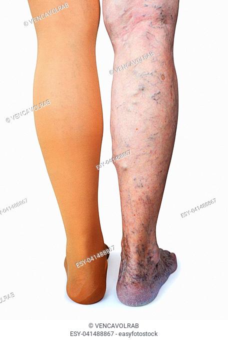 Thrombosis stockings on a leg of old woman isolated on white background