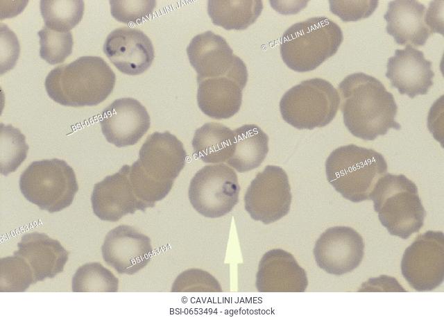 PLASMODIUM FALCIPARUM MALARIA<BR>Plasmodium falciparum. Magnification : 1000x
