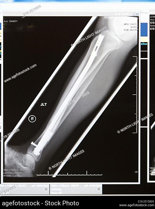Canada, BC, North Vancouver. X-ray of broken leg repair. Fibula and tibia