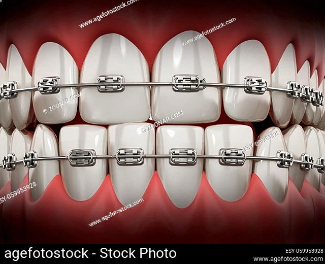 Illustration showing dental braces on straight teeth. 3D illustration