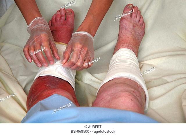 VENOUS INSUFFICIENCY Photo essay from hospital. Emergency services. Edema, arteriopathy, venous insufficiency. Care