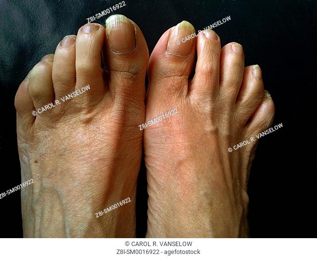 Feet of a woman who is in serious need of a pedicure. Uneven and calciferous nails