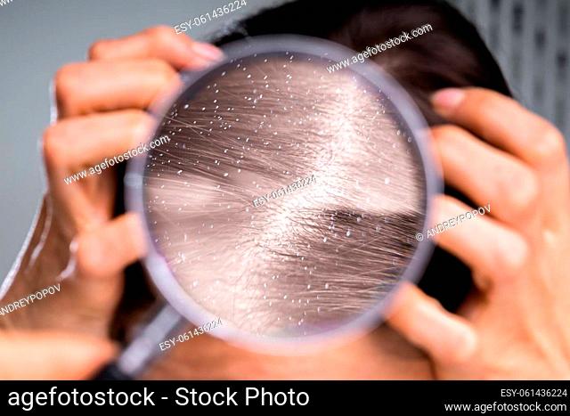 Close-up Of A Dandruff In Blonde Hair Seen Through Magnifying Glass