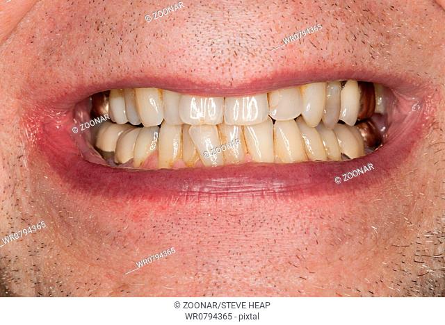 Macro image of filled teeth