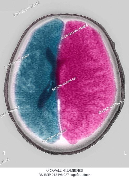 Cerebral edema (in the left hemisphere). Cross-section scan of the skull