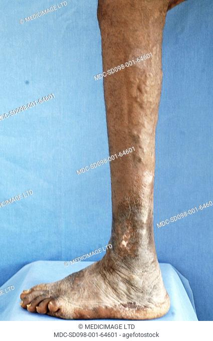 Varicose veins are those distended, lengthened, and tortuous./nThe superficial veins of the legs are most commonly affected
