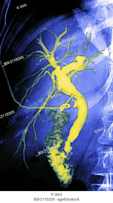 CHOLANGIOGRAPHY<BR> <BR>Cholangiography (Radiography of the biliary airways previously opacified with a iodined contrast media water-soluble administered...
