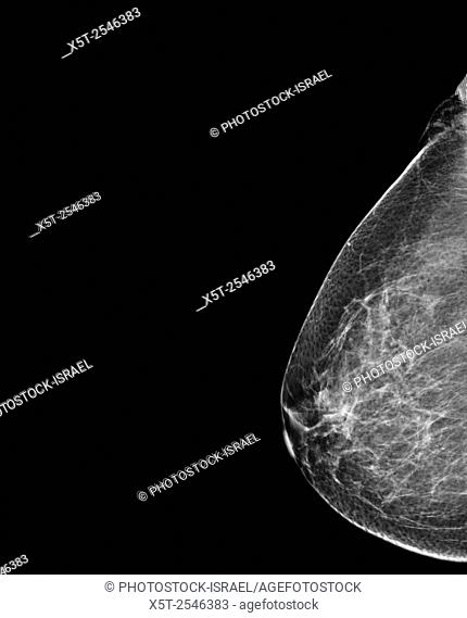 Breast Mammography. X-ray of woman's breast for early identification of breast cancer. Breast cancer is the most common type of cancer in women