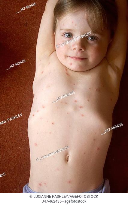 Outstretched 3 year old girl smiling into camera covered in chickenpox