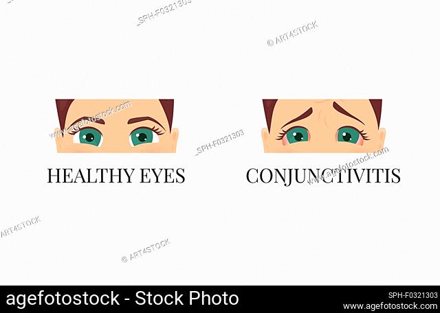 Conjunctivitis versus healthy eyes, conceptual illustration
