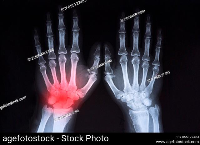Human's hand's x ray highlighted in red
