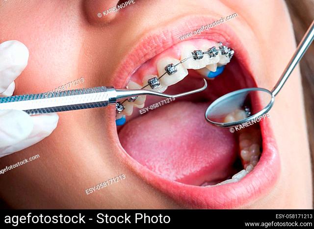 Extreme macro close up of open human mouth showing stainless steel braces