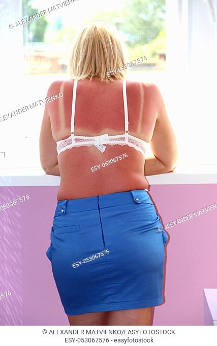 Modern woman in bra with sunburn on her back in blue skirt standing with her back on balcony. Burns on female back after visiting beach