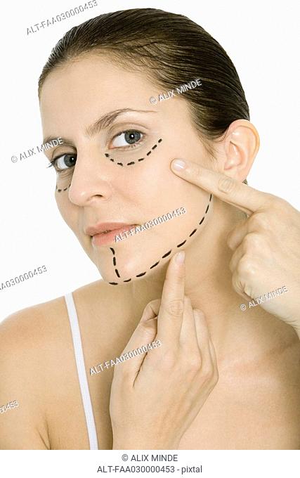 Woman pointing at plastic surgery markings on face, looking at camera