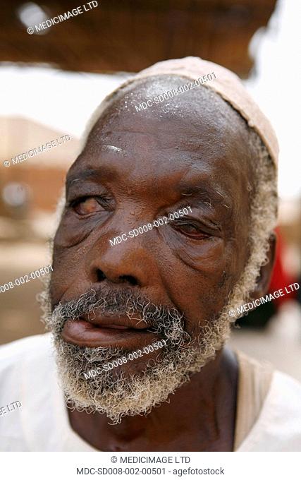 Close up of the face of a man suffering from leprosy. A chronic inflammatory disease, leprosy is caused by mycobacterium leprae
