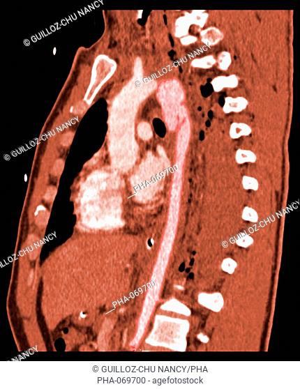 Sagittal Computed Tomography CT scan of false aneurysm of the aorta seen as a swelling on the upper aorta pink, below the aortic arch