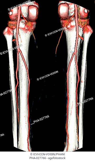 3D computed tomographic CT scan reconstruction of the lower part of the leg showing the bones of the knee, fibula and tibia