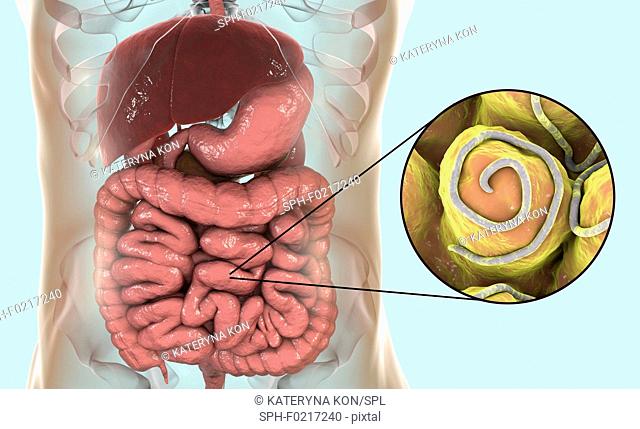 Threadworm infection, illustration