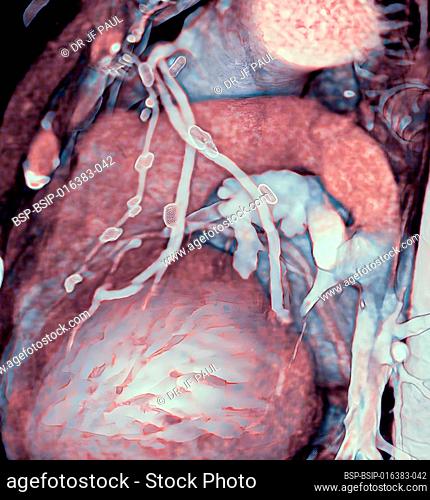 3D CT scan of coronary bypasses