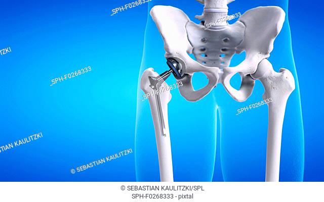 Hip replacement, computer illustration