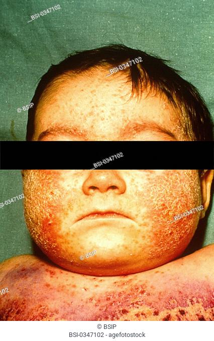 ECZEMA IN AN INFANT