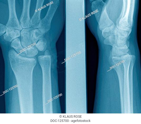 X - ray photograph of a surgical practice . The radiograph shows : Wrist o . B