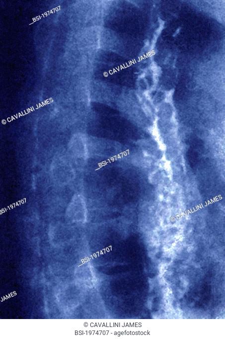 ESOPHAGEAL VARIX, X-RAY Varicose veins of the esophagus. Sagittal thoracic x-ray. Esophageal varicose veins are abnormal dilations of inferior veins of the...
