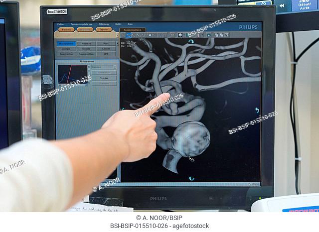 Reportage in the interventional neuroradiology service in Pasteur 2 Hospital, Nice, France. Treating a cerebral aneurysm through embolization