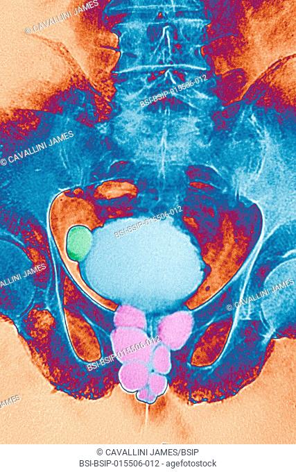 Prostate caverns and diverticulum in the bladder. Frontal pelvic x-ray