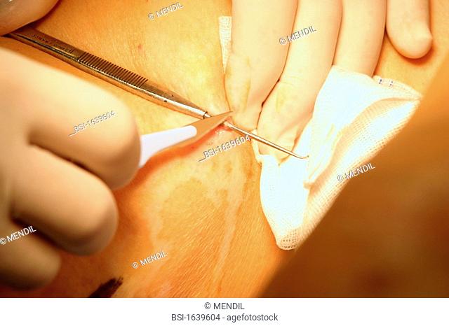 VEIN SURGERY<BR>Photo essay from clinic.<BR>Reims, France. Preparing vein for phlebectomy, a partial or complete removal of a vein