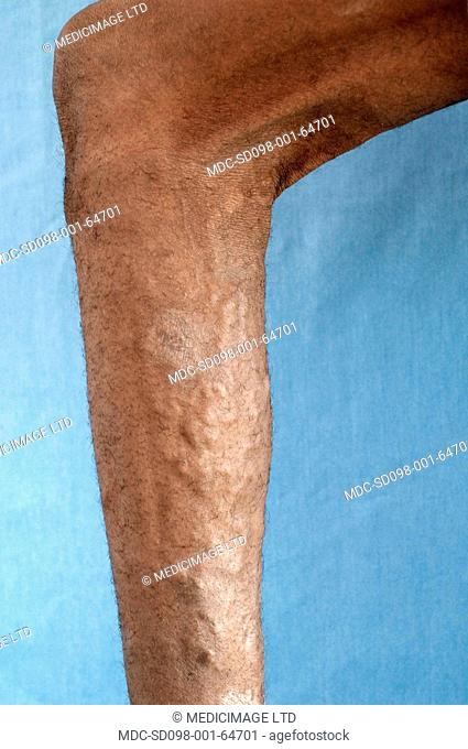 Varicose veins are those distended, lengthened, and tortuous./nThe superficial veins of the legs are most commonly affected