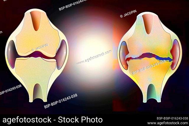 Anatomy of the joint of a healthy knee on the left, and one deformed by osteoarthritis on the right