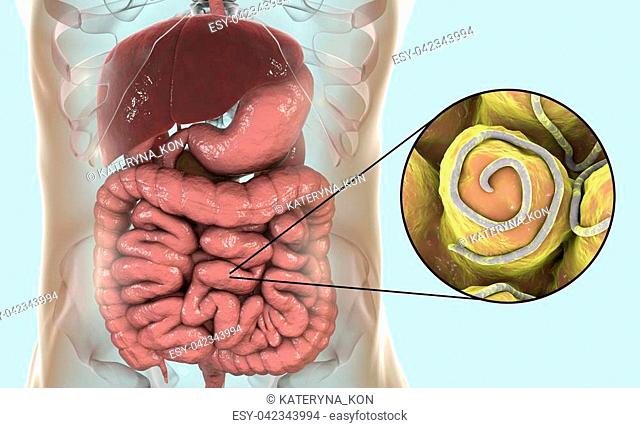 Helminths nematodes Enterobius in the gut. Threadworm which causes enterobiasis, 3D illustration showing close-up view of threadworms located in large intestine